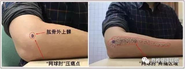 网球肘的康复治疗方案详解(图1)