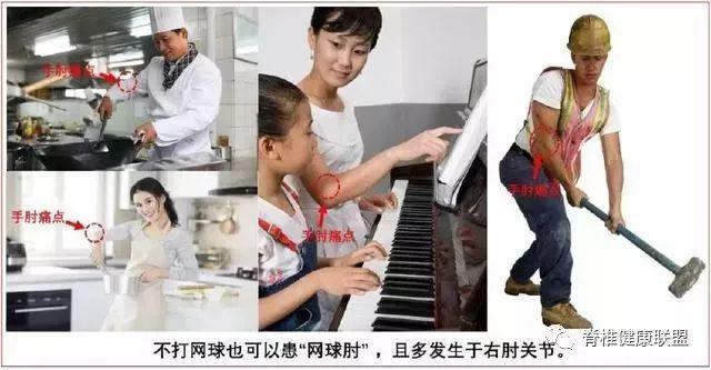 网球肘的康复治疗方案详解(图2)